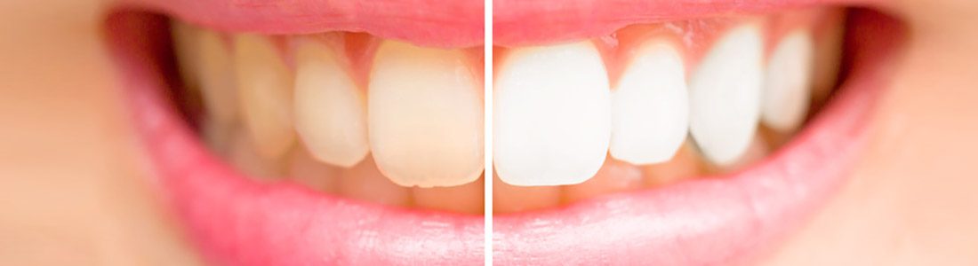 Zahnaufhellung mit Bleaching oder Veneers